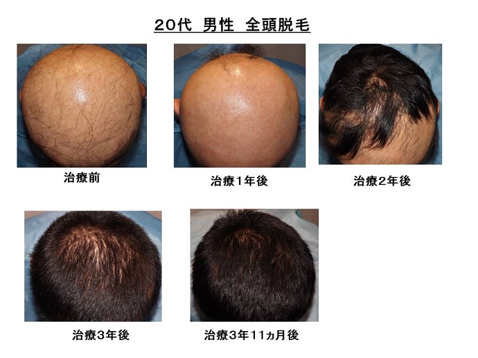 円形脱毛症　病院""